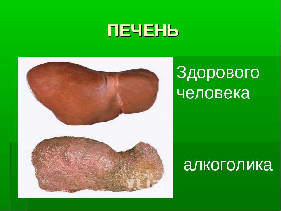 Как выглядит печень алкоголика